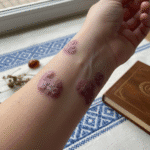 Dedervinė: Klastinga odos problema, kurią dažnai painiojame su kitais bėrimais