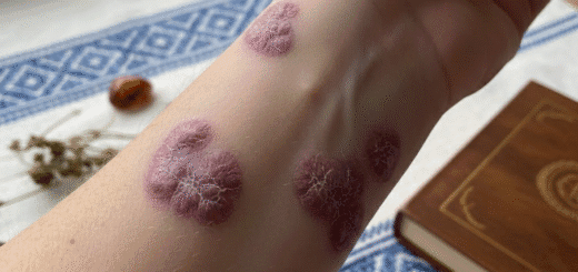 Dedervinė: Klastinga odos problema, kurią dažnai painiojame su kitais bėrimais